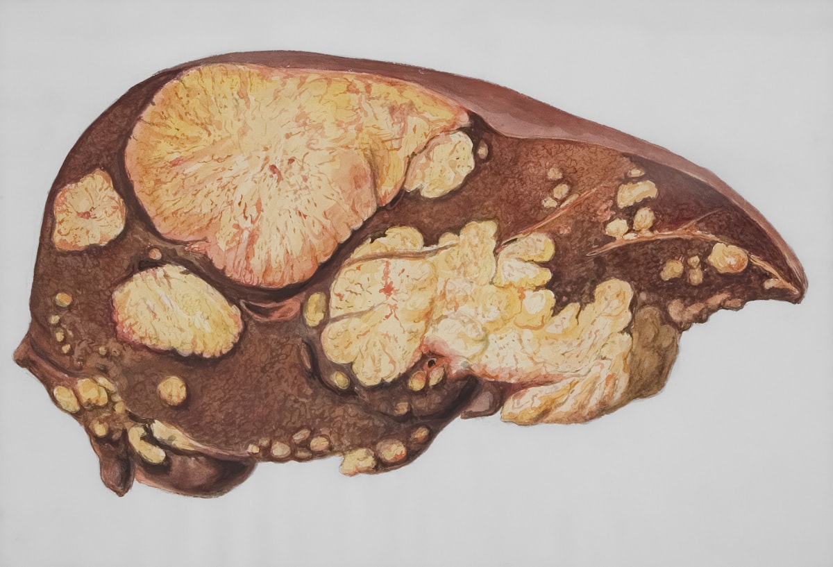 ION224 for Fatty Liver: What It
